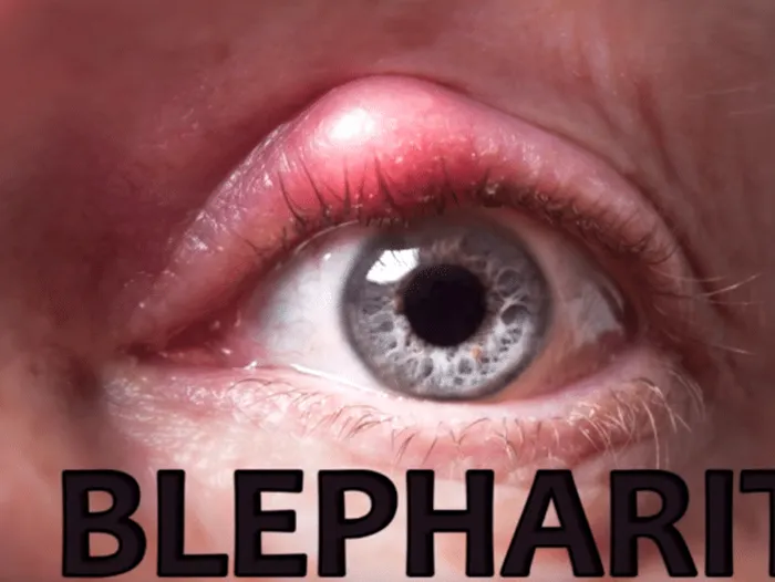 blepharitis eye condition