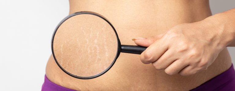 How to Hide Stretch Marks? Causes & 10 Proven Natural Treatments